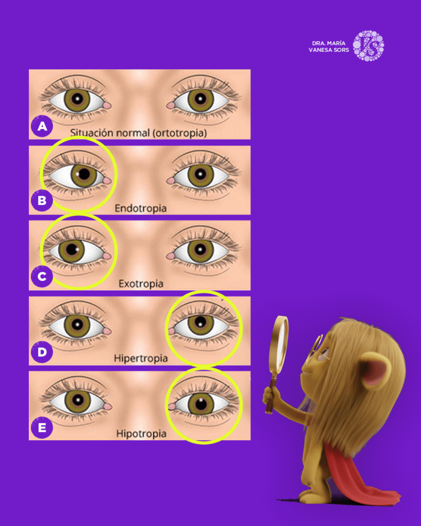 carrusel-estrabismo_04